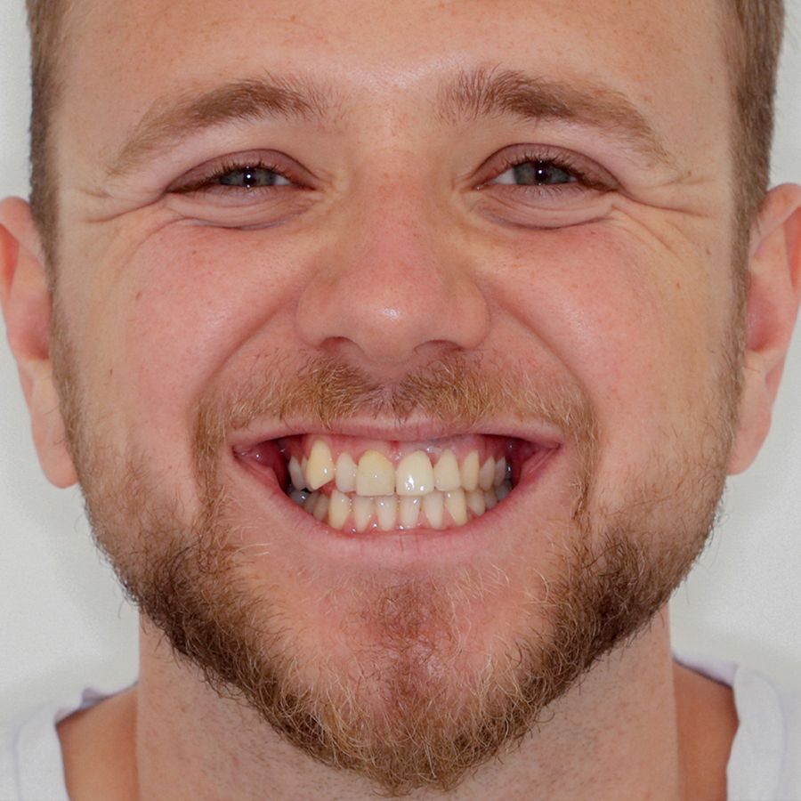 Invisalign vs Invisible Braces - before - 3Dental